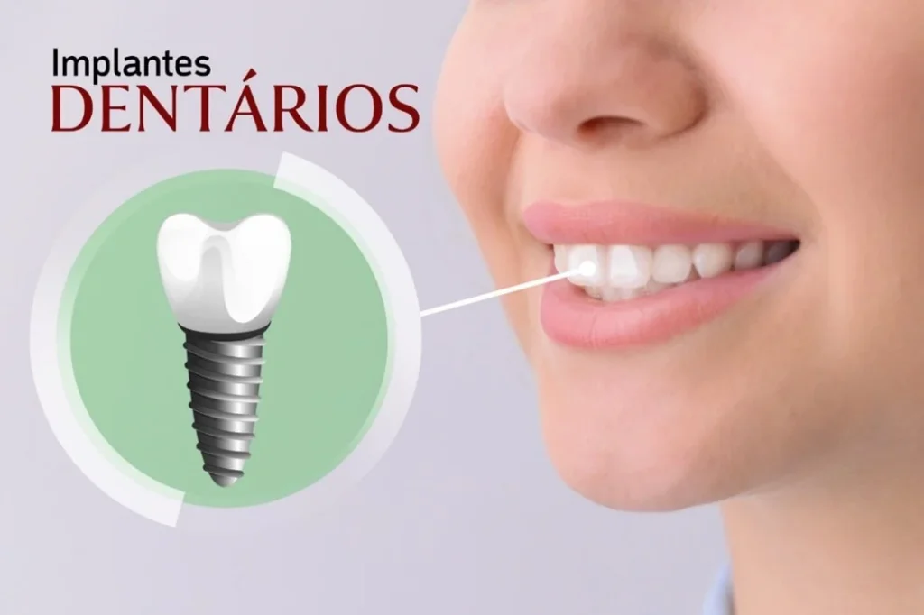 implantes