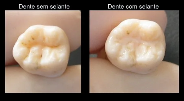 selantes dentários
