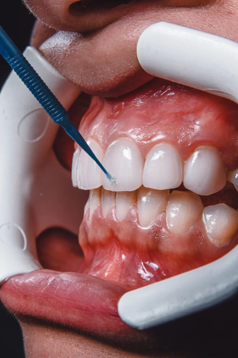 Dentisteria Estética